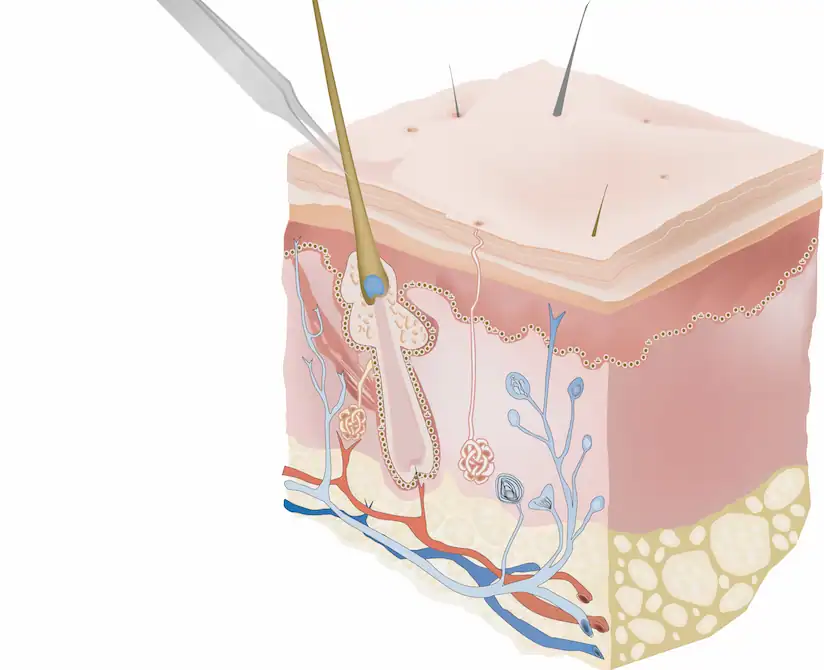 2ème étape : Épilation